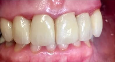 Patient 1 after treatment at Matley Dental
