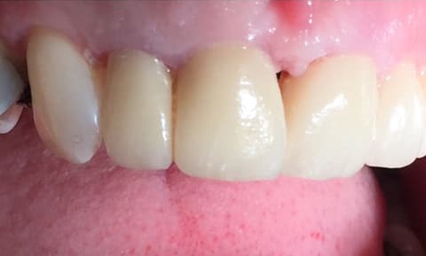 Patient 2 after treatment at Matley Dental