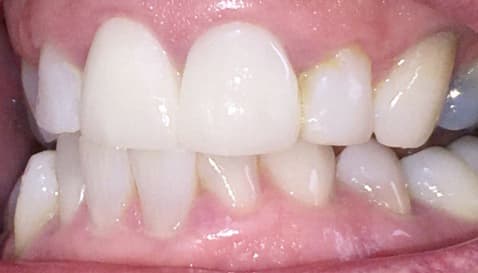 Patient 3 after treatment at Matley Dental