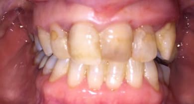 Patient 1 before treatment at Matley Dental