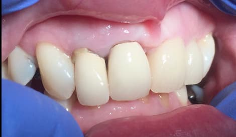 Patient 2 before treatment at Matley Dental