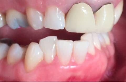 Patient 3 before treatment at Matley Dental
